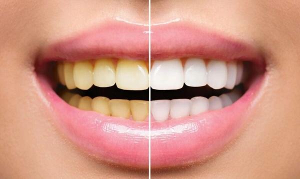 چرا رنگ دندان تغییر می نماید؟