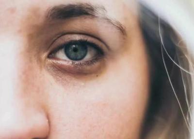 برترین روش ها برای درمان چروک های دور چشم