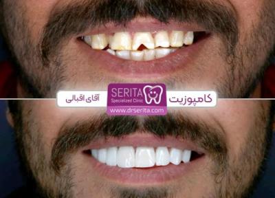 کامپوزیت دندان برای چه کسانی مناسب است؟